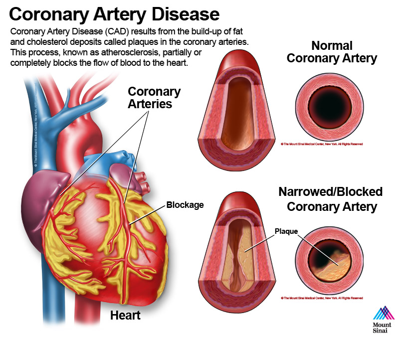 Coronary Artery Disease (CAD)